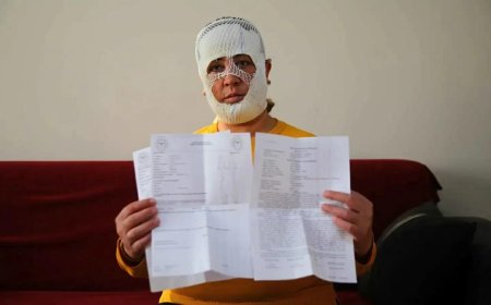 كارثة تجميل في تركيا.. "وجه الأميرة" يتحول إلى حروق مؤلمة