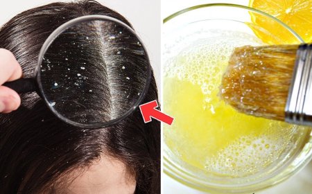 أفضل طرق علاج القشرة نهائيًا بوسائل طبيعية فعالة وسهلة في المنزل