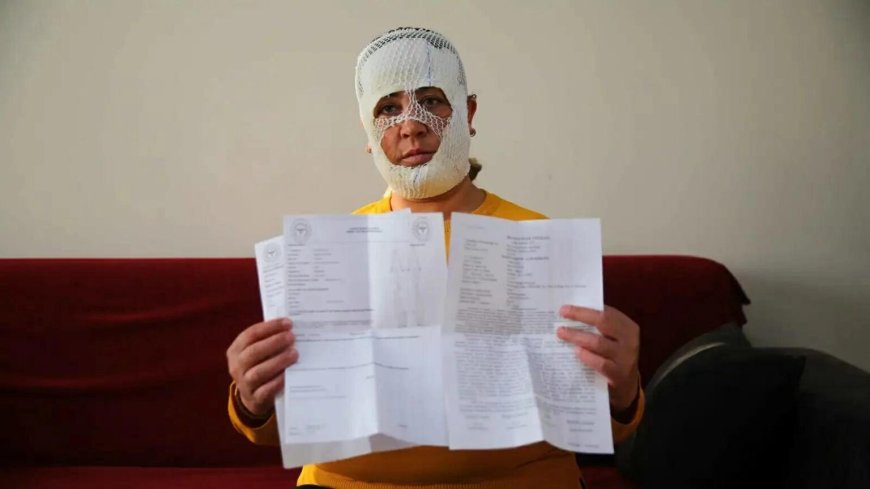 كارثة تجميل في تركيا.. "وجه الأميرة" يتحول إلى حروق مؤلمة