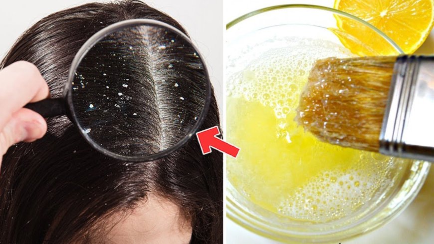 أفضل طرق علاج القشرة نهائيًا بوسائل طبيعية فعالة وسهلة في المنزل