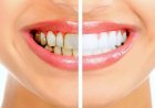 كيفية التخلص من اصفرار الأسنان بطرق طبيعية فعالة لاستعادة بياض الابتسامة