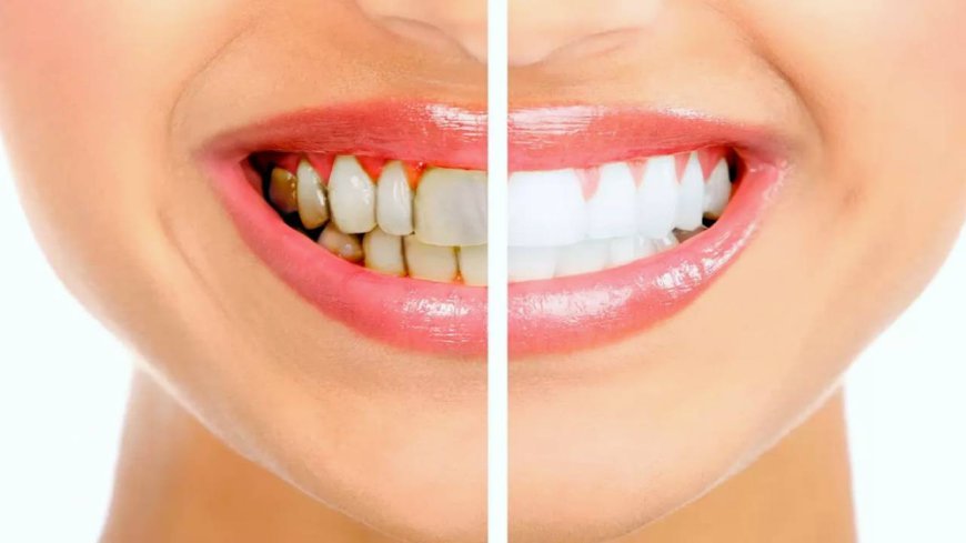 كيفية التخلص من اصفرار الأسنان بطرق طبيعية فعالة لاستعادة بياض الابتسامة