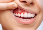 أمراض اللثة.. كيف تؤثر بكتيريا الفم على استقرار قلبك؟