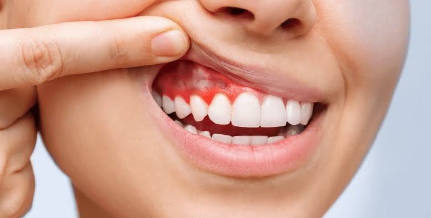 أمراض اللثة.. كيف تؤثر بكتيريا الفم على استقرار قلبك؟